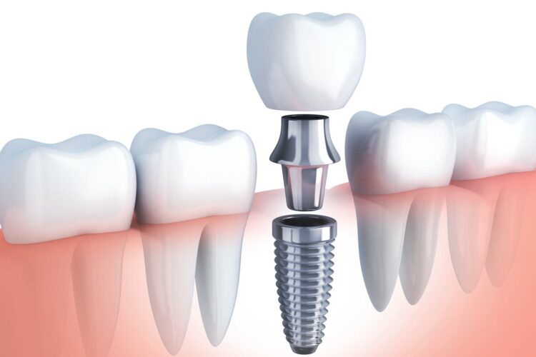 implantes dentales en sotillo de la adrada